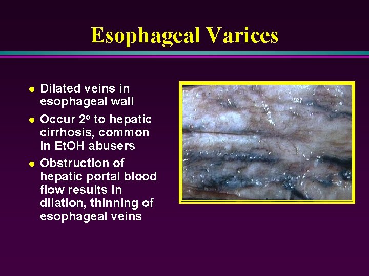 Esophageal Varices l l l Dilated veins in esophageal wall Occur 2 o to