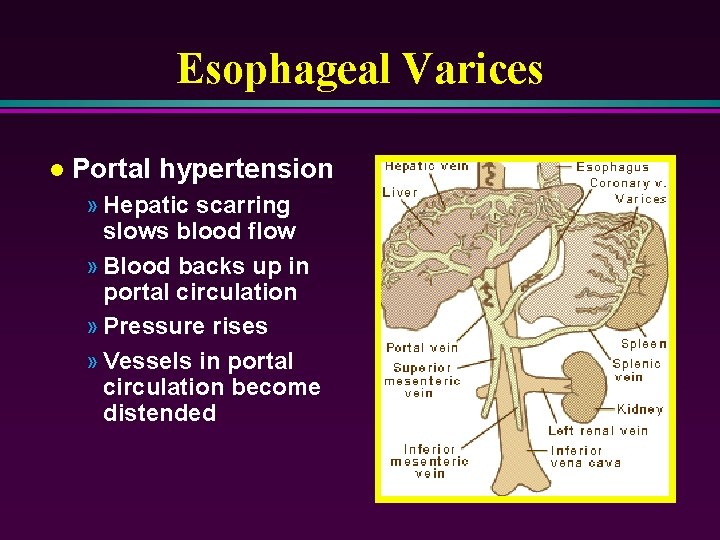 Esophageal Varices l Portal hypertension » Hepatic scarring slows blood flow » Blood backs