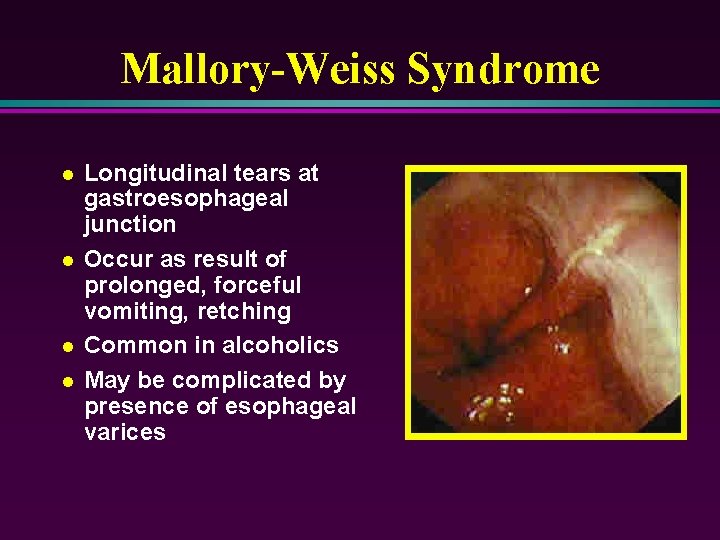 Mallory-Weiss Syndrome l l Longitudinal tears at gastroesophageal junction Occur as result of prolonged,