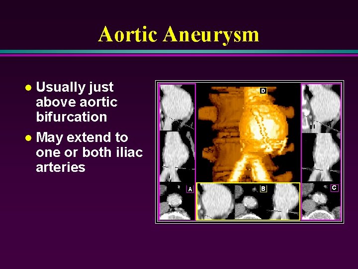 Aortic Aneurysm Usually just above aortic bifurcation l May extend to one or both