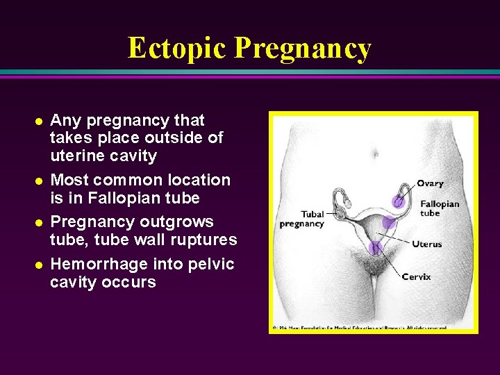 Ectopic Pregnancy l l Any pregnancy that takes place outside of uterine cavity Most