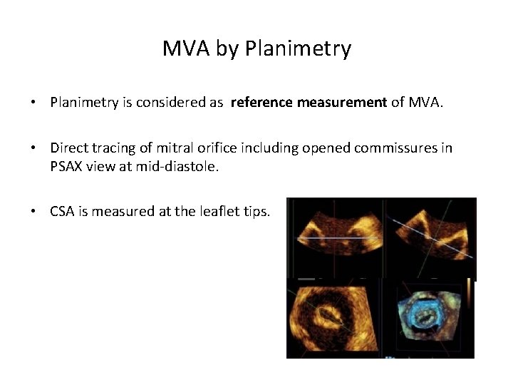 MVA by Planimetry • Planimetry is considered as reference measurement of MVA. • Direct