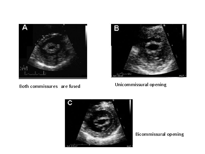 Both commissures are fused Unicommissural opening Bicommissural opening 
