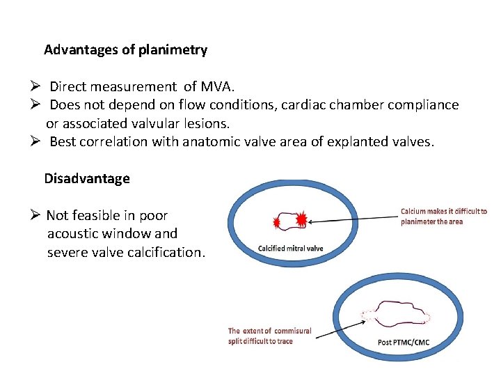 Advantages of planimetry Ø Direct measurement of MVA. Ø Does not depend on flow