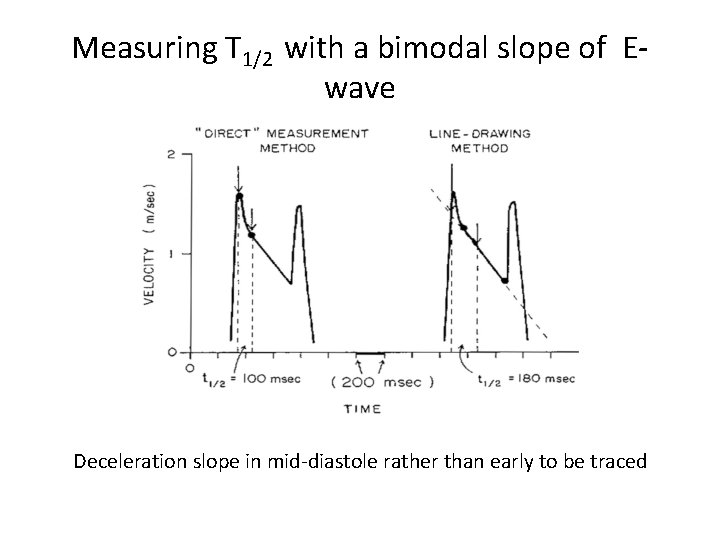 Measuring T 1/2 with a bimodal slope of Ewave Deceleration slope in mid-diastole rather