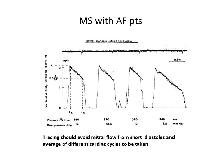MS with AF pts Tracing should avoid mitral flow from short diastoles and average