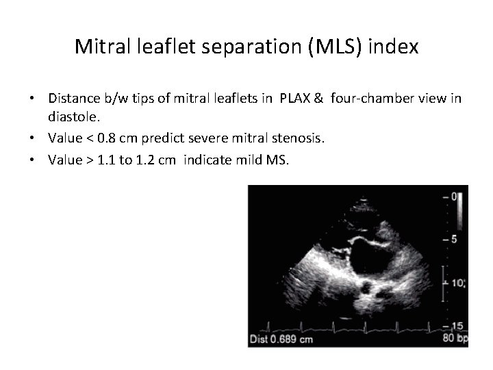 Mitral leaflet separation (MLS) index • Distance b/w tips of mitral leaflets in PLAX
