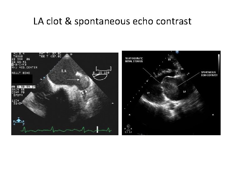 LA clot & spontaneous echo contrast 