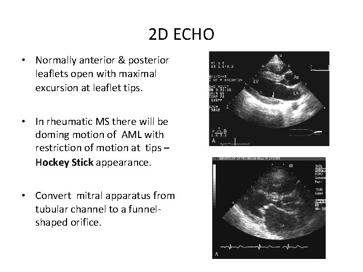 2 D ECHO • Normally anterior & posterior leaflets open with maximal excursion at