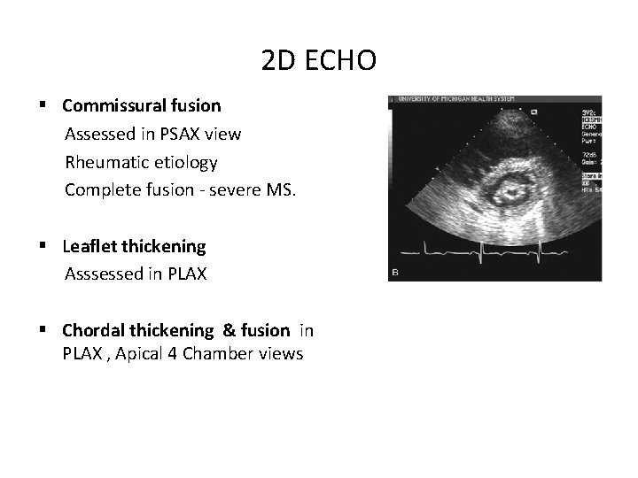 2 D ECHO § Commissural fusion Assessed in PSAX view Rheumatic etiology Complete fusion