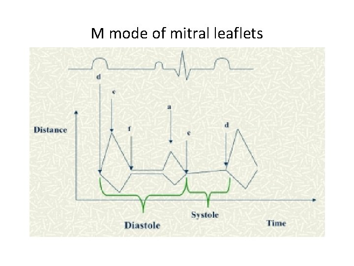 M mode of mitral leaflets 