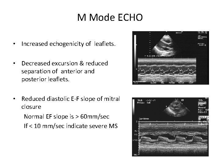 M Mode ECHO • Increased echogenicity of leaflets. • Decreased excursion & reduced separation
