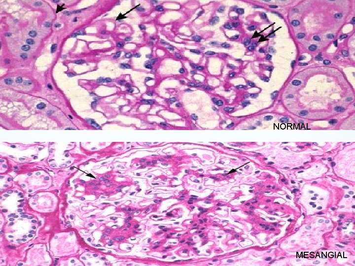 NORMAL MESANGIAL 