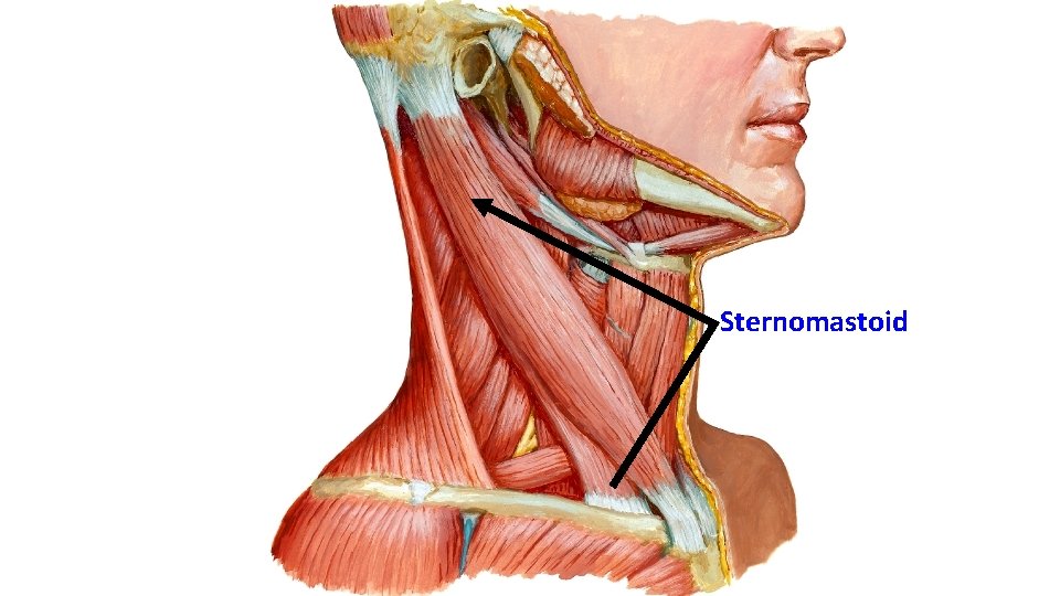 Sternomastoid 