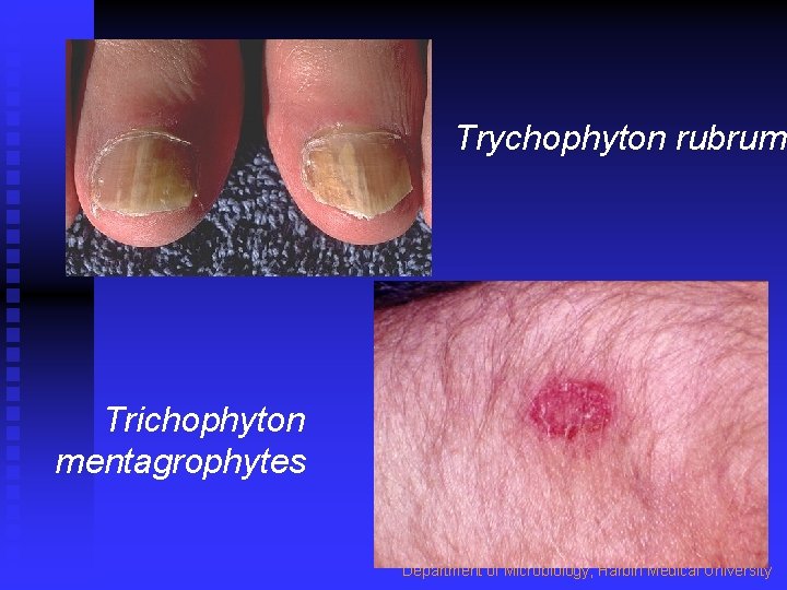 Trychophyton rubrum Trichophyton mentagrophytes Department of Microbiology, Harbin Medical University 