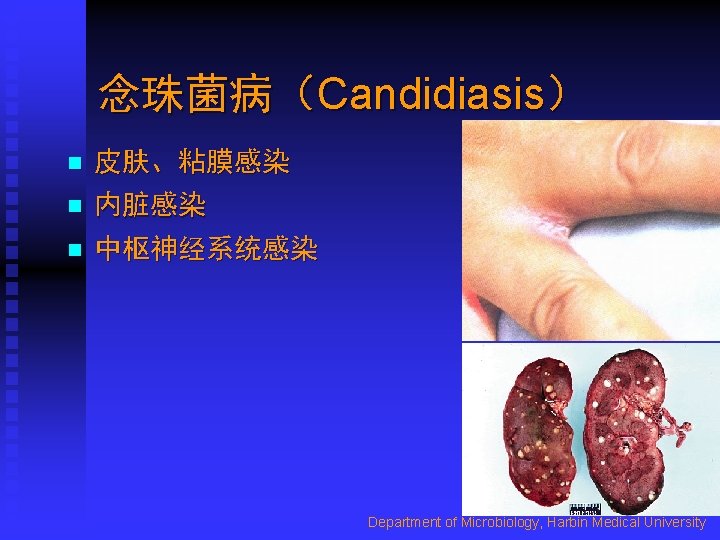 念珠菌病（Candidiasis） n 皮肤、粘膜感染 n 内脏感染 n 中枢神经系统感染 Department of Microbiology, Harbin Medical University 