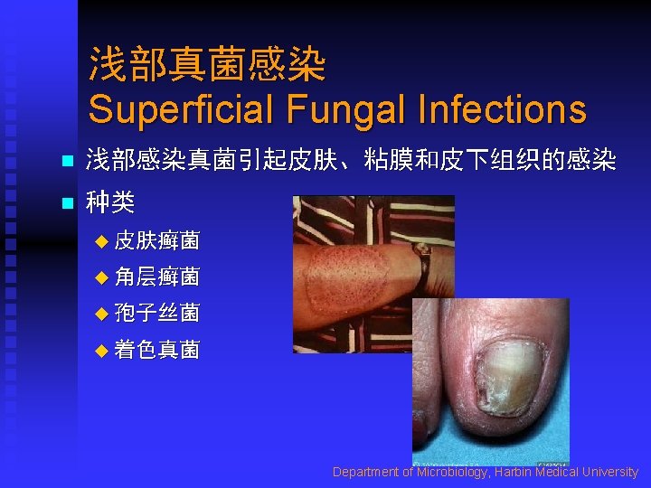 浅部真菌感染 Superficial Fungal Infections n 浅部感染真菌引起皮肤、粘膜和皮下组织的感染 n 种类 u 皮肤癣菌 u 角层癣菌 u 孢子丝菌