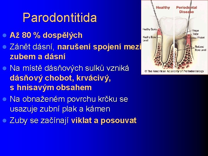 Parodontitida l l l Až 80 % dospělých Zánět dásní, narušení spojení mezi zubem