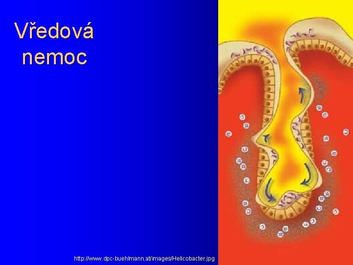 Vředová nemoc http: //www. dpc-buehlmann. at/images/Helicobacter. jpg 