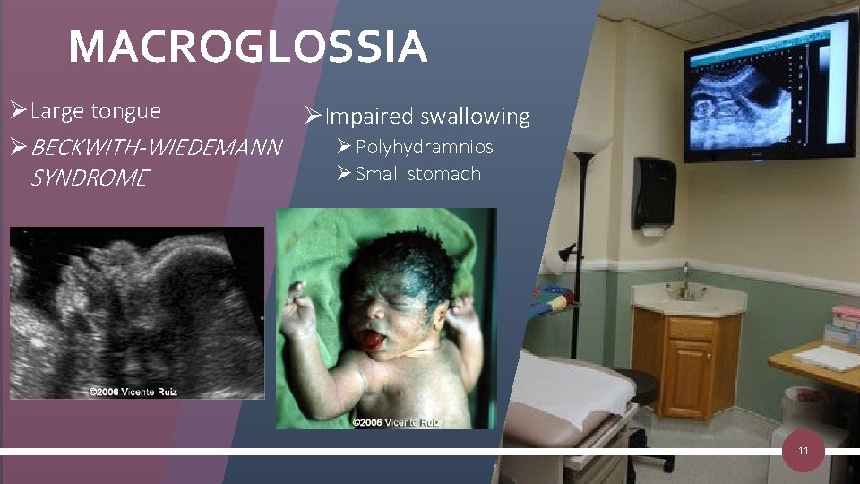 MACROGLOSSIA ØLarge tongue ØImpaired swallowing Ø Polyhydramnios ØBECKWITH-WIEDEMANN Ø Small stomach SYNDROME 11 