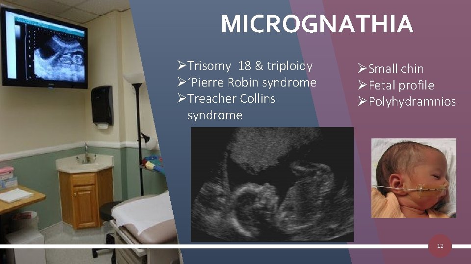 MICROGNATHIA ØTrisomy 18 & triploidy Ø‘Pierre Robin syndrome ØTreacher Collins syndrome ØSmall chin ØFetal