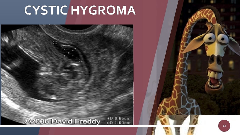 CYSTIC HYGROMA ØMC neck mass ØMalformed lymphatic system ØCystic areas around posterior neck ØFetal