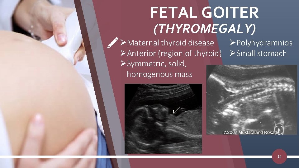 FETAL GOITER (THYROMEGALY) ØPolyhydramnios ØMaternal thyroid disease ØAnterior (region of thyroid) ØSmall stomach ØSymmetric,