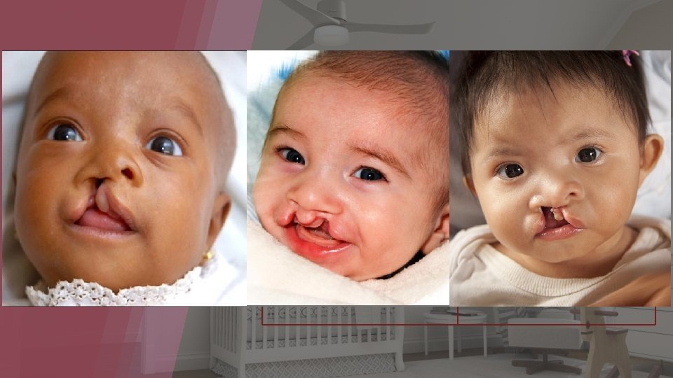 CLEFT LIP/ PALATE ACROCEPHALOPOLYSYNDACTYLY SPONDYLOEPIPHYSEAL DYSPLASIA CONGENITA AMNIOTIC BAND SYNDROME MECKEL-GRUBER SYNDROME ANENCEPHALY ROBERT’S