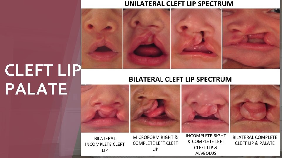CLEFT LIP/ PALATE ØMC congenital anomaly of the face ØAsian: 1 per 350 births