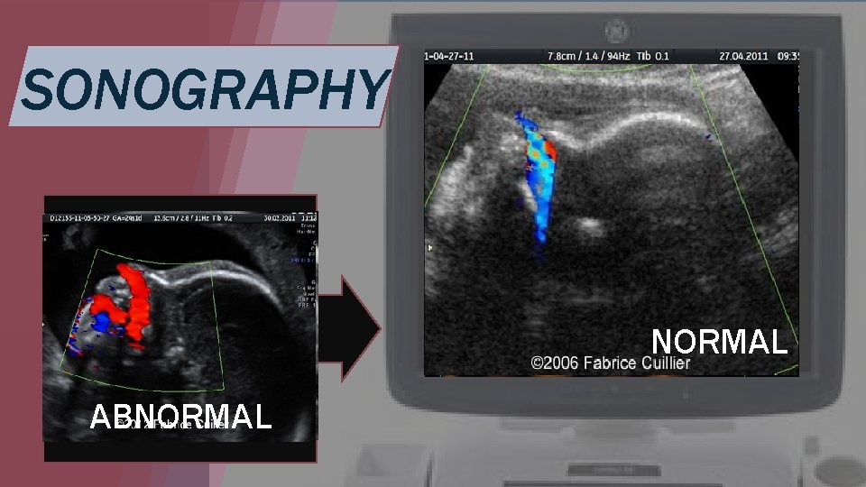 SONOGRAPHY NORMAL ABNORMAL 