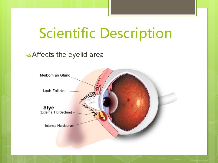 Scientific Description Affects the eyelid area 