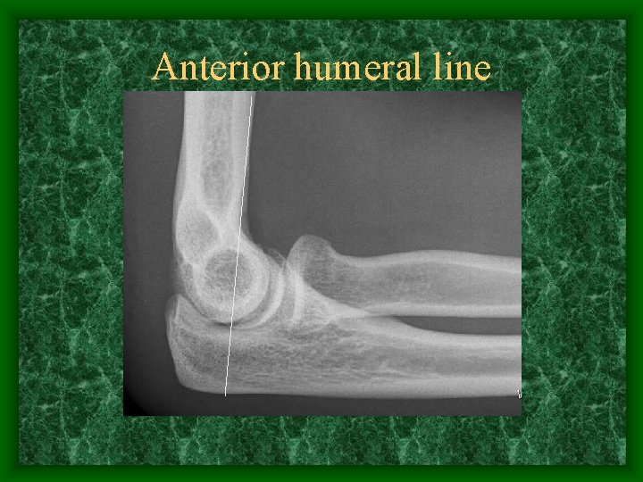 Anterior humeral line 