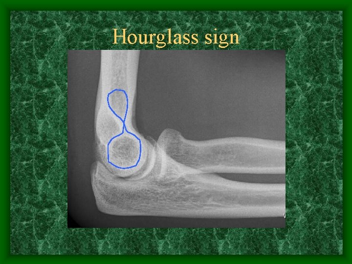 Hourglass sign 