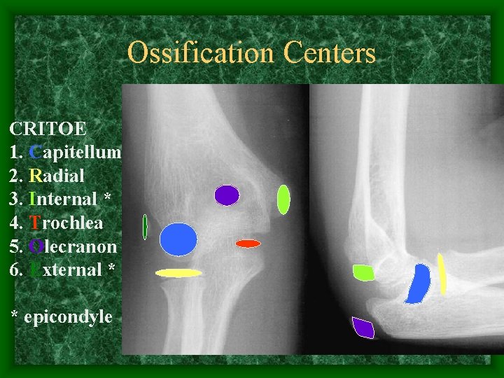 Ossification Centers CRITOE 1. Capitellum 2. Radial 3. Internal * 4. Trochlea 5. Olecranon