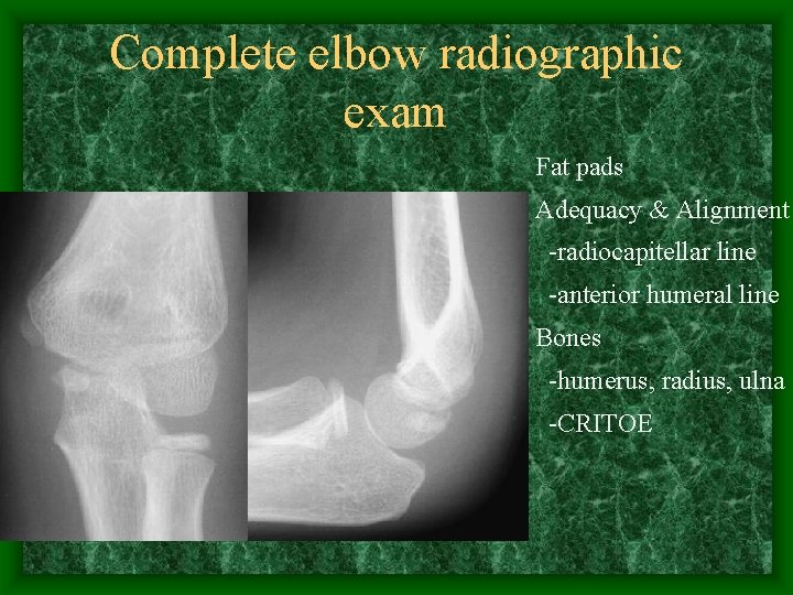 Complete elbow radiographic exam Fat pads Adequacy & Alignment -radiocapitellar line -anterior humeral line