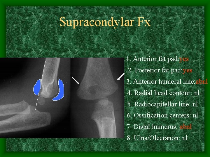 Supracondylar Fx 1. Anterior fat pad: yes 2. Posterior fat pad: yes 3. Anterior