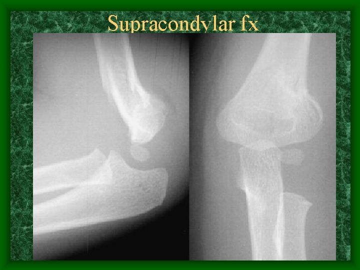 Supracondylar fx 