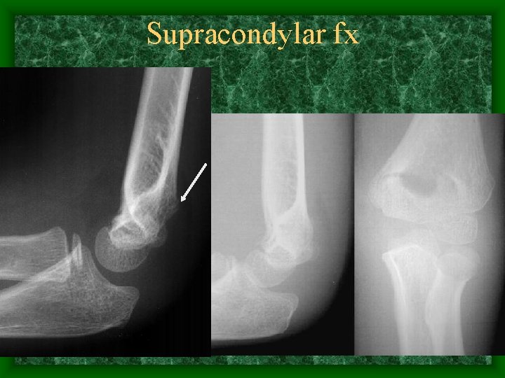 Supracondylar fx 