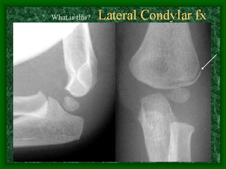 What is this? Lateral Condylar fx 
