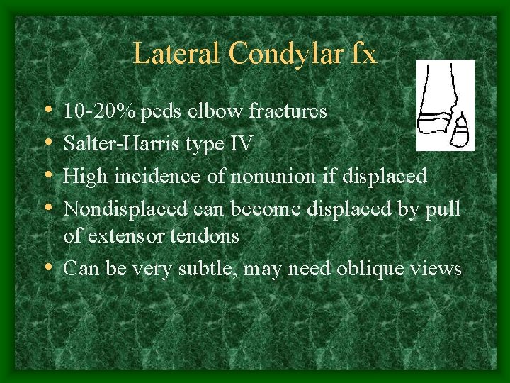 Lateral Condylar fx • • 10 -20% peds elbow fractures Salter-Harris type IV High