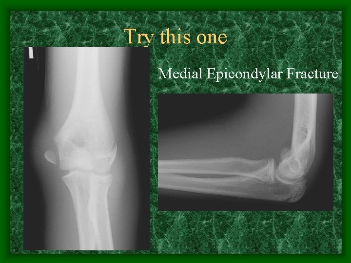 Try this one Medial Epicondylar Fracture 