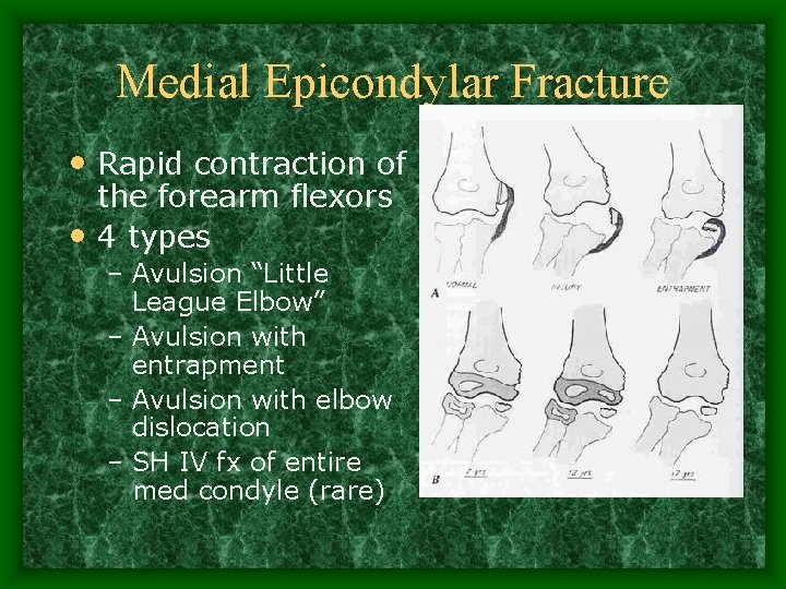 Medial Epicondylar Fracture • Rapid contraction of the forearm flexors • 4 types –