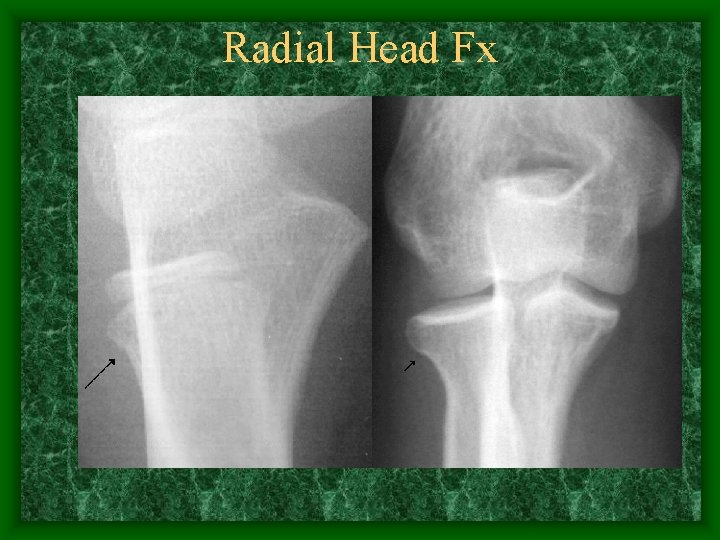 Radial Head Fx 