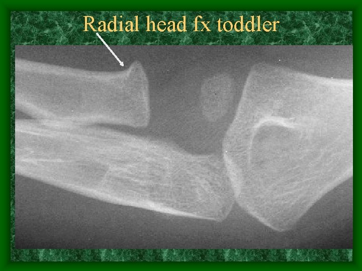 Radial head fx toddler 