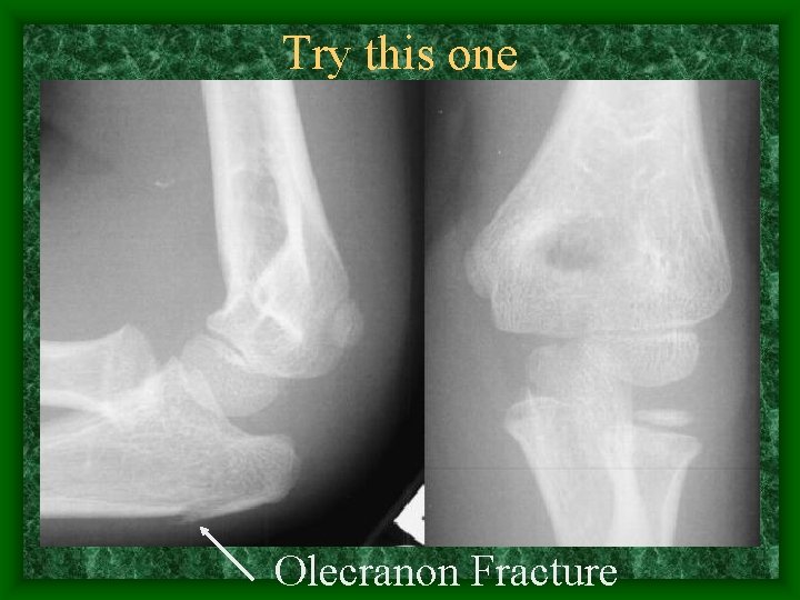 Try this one Olecranon Fracture 