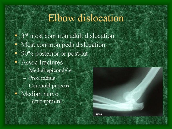 Elbow dislocation • • 3 rd most common adult dislocation Most common peds dislocation