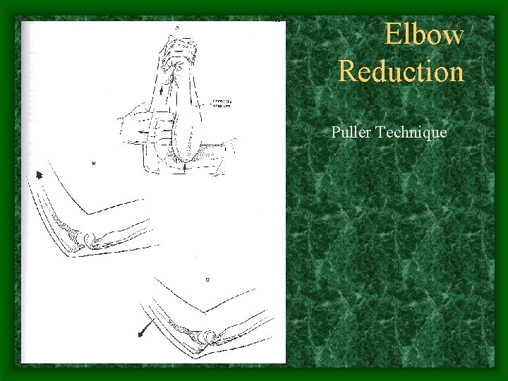 Elbow Reduction Puller Technique 