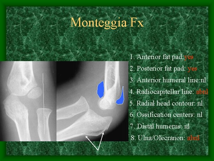 Monteggia Fx 1. Anterior fat pad: yes 2. Posterior fat pad: yes 3. Anterior