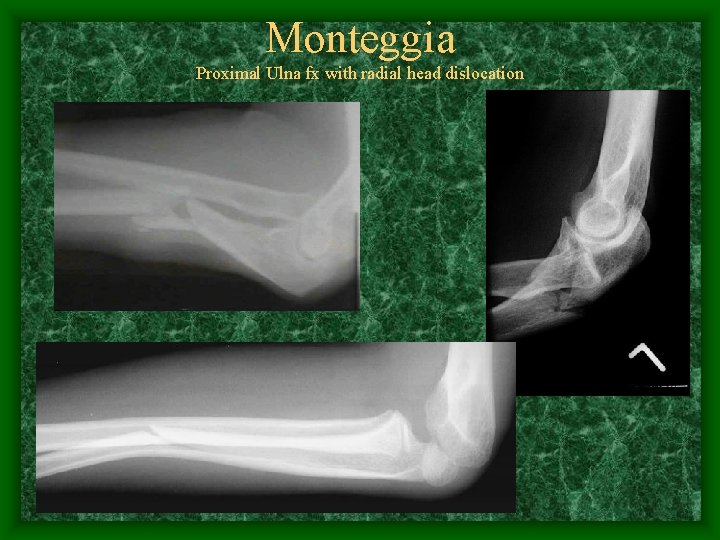 Monteggia Proximal Ulna fx with radial head dislocation 
