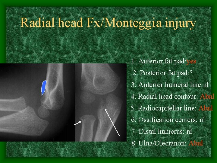 Radial head Fx/Monteggia injury 1. Anterior fat pad: yes 2. Posterior fat pad: ?